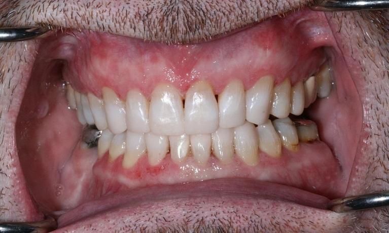 Composite-Fillings-After-Image