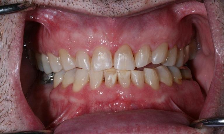 Composite-Fillings-Before-Image